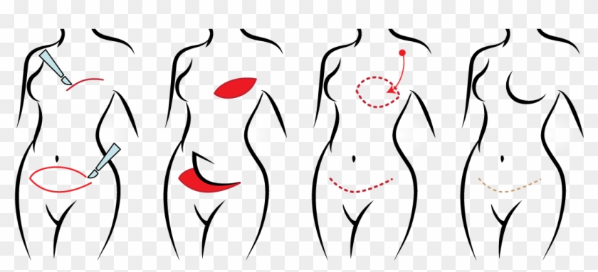 Flap Techniques Allow For Collection Of This Tissue Clipart