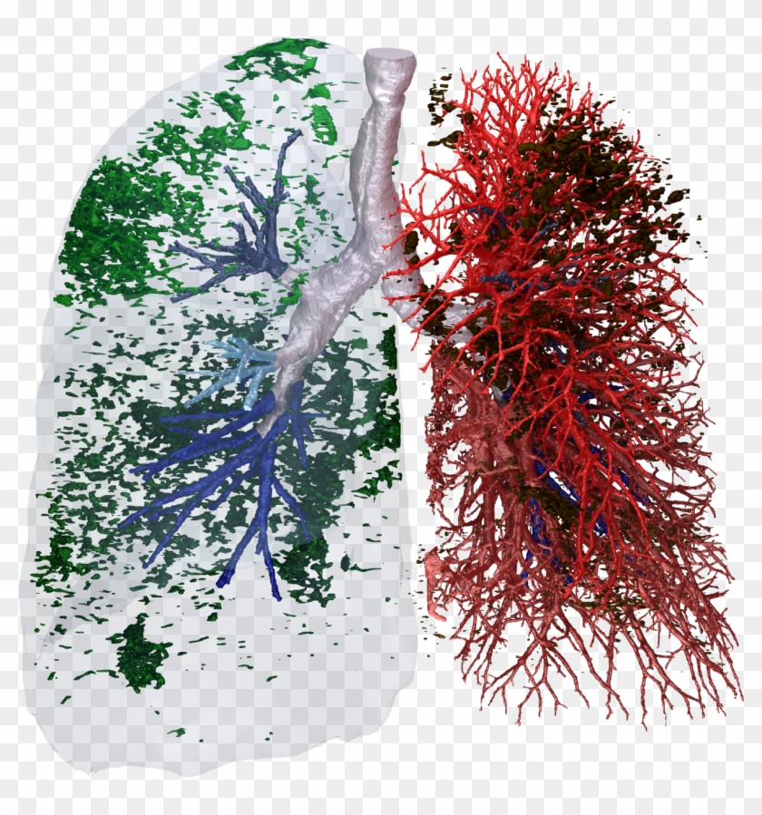 Functional Respiratory Imaging Yields Unparalleled - Lung Function Image Fluidda Copd Clipart