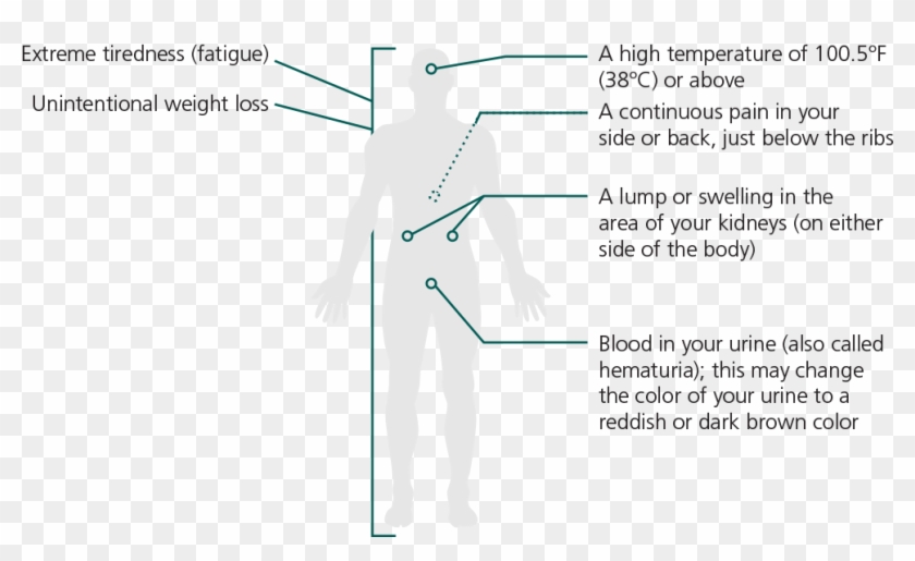 Signs & Symptoms - Renal Cell Carcinoma Lump Clipart