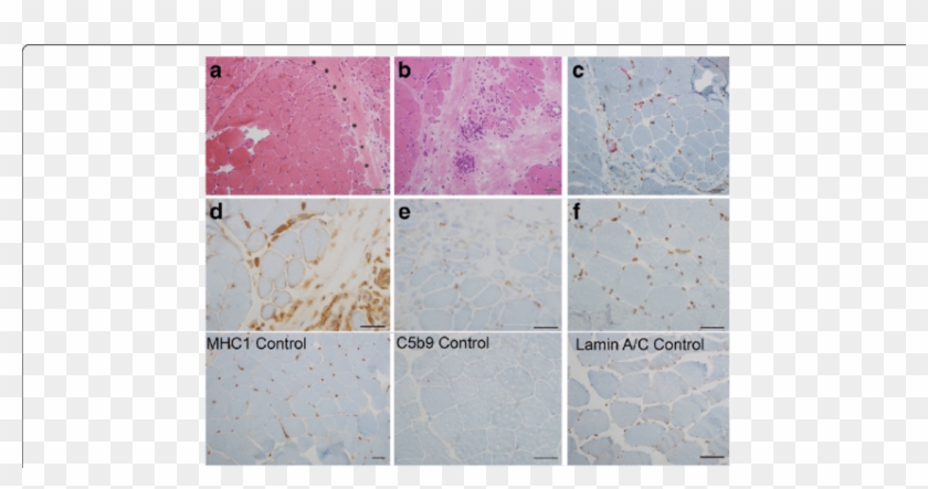 A Hematoxylin Eosin Staining Shows Prominent Perifascicular - Tile Clipart