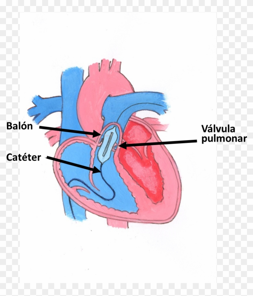 A Través De Una Vena De La Pierna, Se Accede Al Corazón - Valvuloplastia Pulmonar Con Balon Clipart #3411792