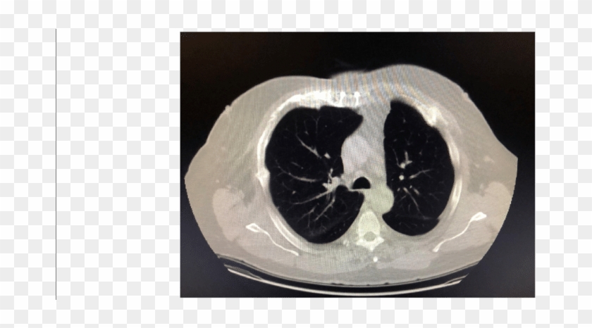 Follow-up Tomography 9 Months Postop, Showing Resolution - Carving Clipart