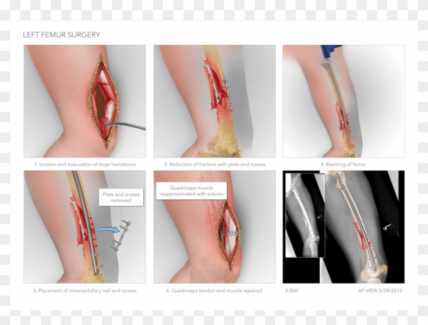 Left Femur Intramedullary Nailing - Intramedullary Nailing Of Femur Fractures Clipart #3480643