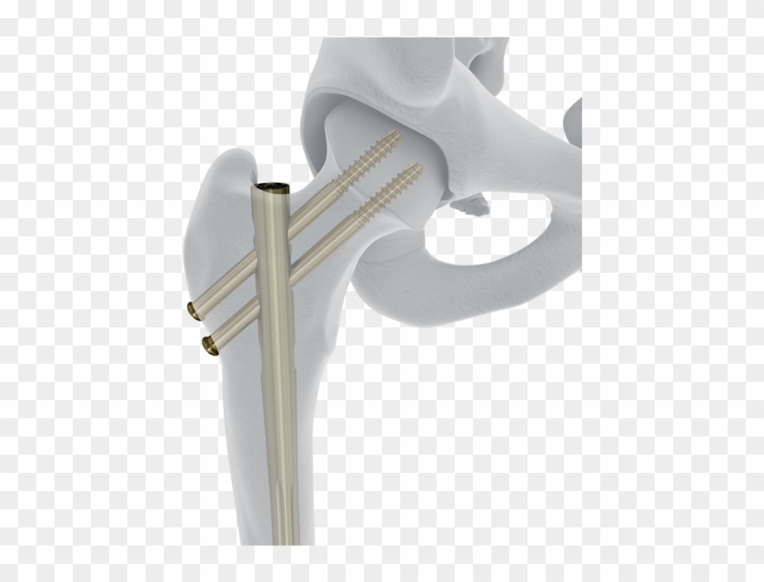 Femoral Recon Nail - Putter Clipart #3480897