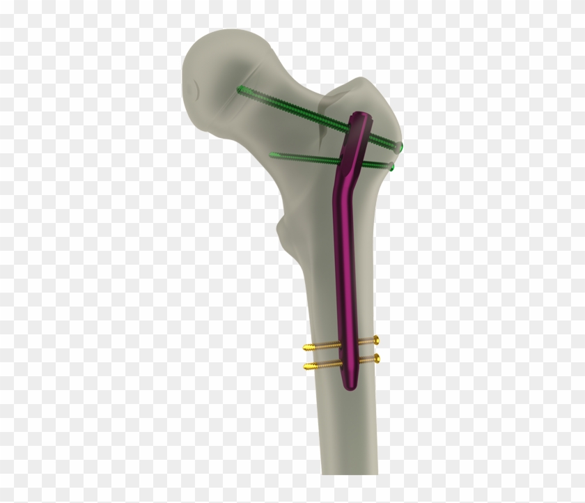 Previousnext - Proksimal Femoral Nail Clipart #3481566