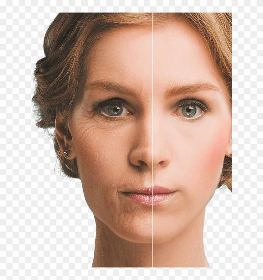 Woman's Face Before And After Botox - American Plastic Surgery Craze Clipart #3487988