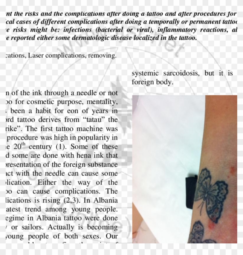 Reddish Purple Papules And Nodules Arranged In An Annular - Tattoo Clipart #3553031