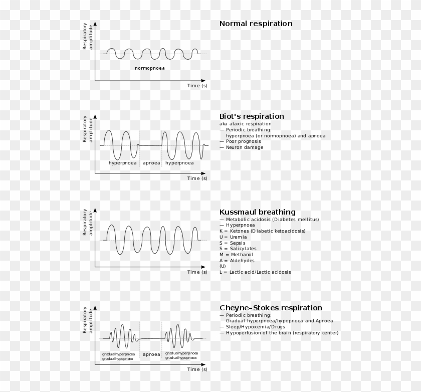 170 × 240 Pixels - Kussmaul Breathing Clipart #3556340