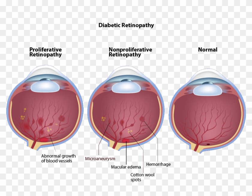 Click To Enlarge - Diabetic Retinopathy Vision Hd Clipart #3563097
