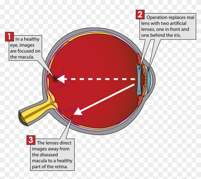 Implantable Miniature Telescope Diagram , Png Download - Implantable Miniature Telescope Diagram Clipart #3563448