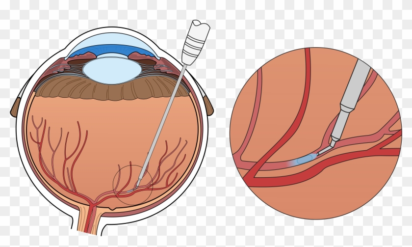 An Error Occurred - Retinal Vein Cannulation Clipart #3569015