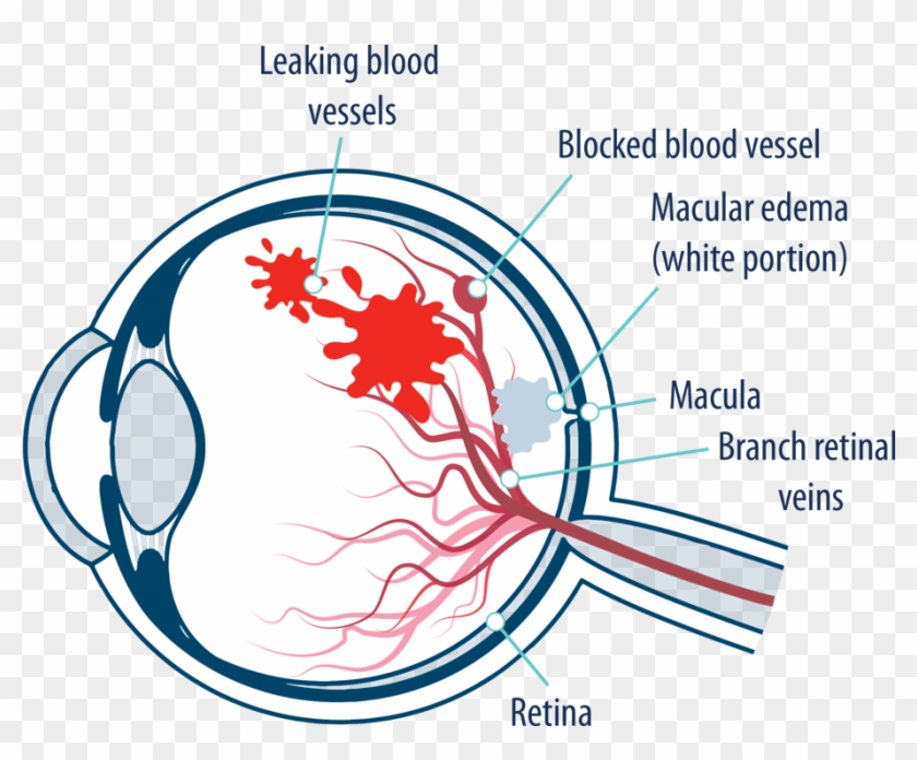 Eye With Macular Edema Following Retinal Vein Occlusion - Leaky Blood Vessels In Eyes Clipart