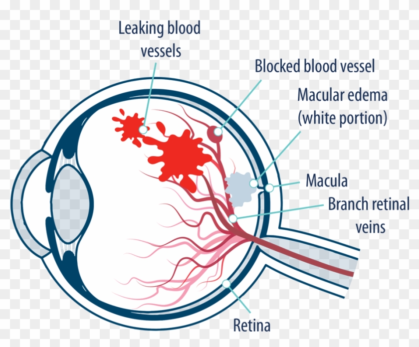 Eye With Macular Edema Following Retinal Vein Occlusion - Leaky Blood Vessels In Eyes Clipart #3569174
