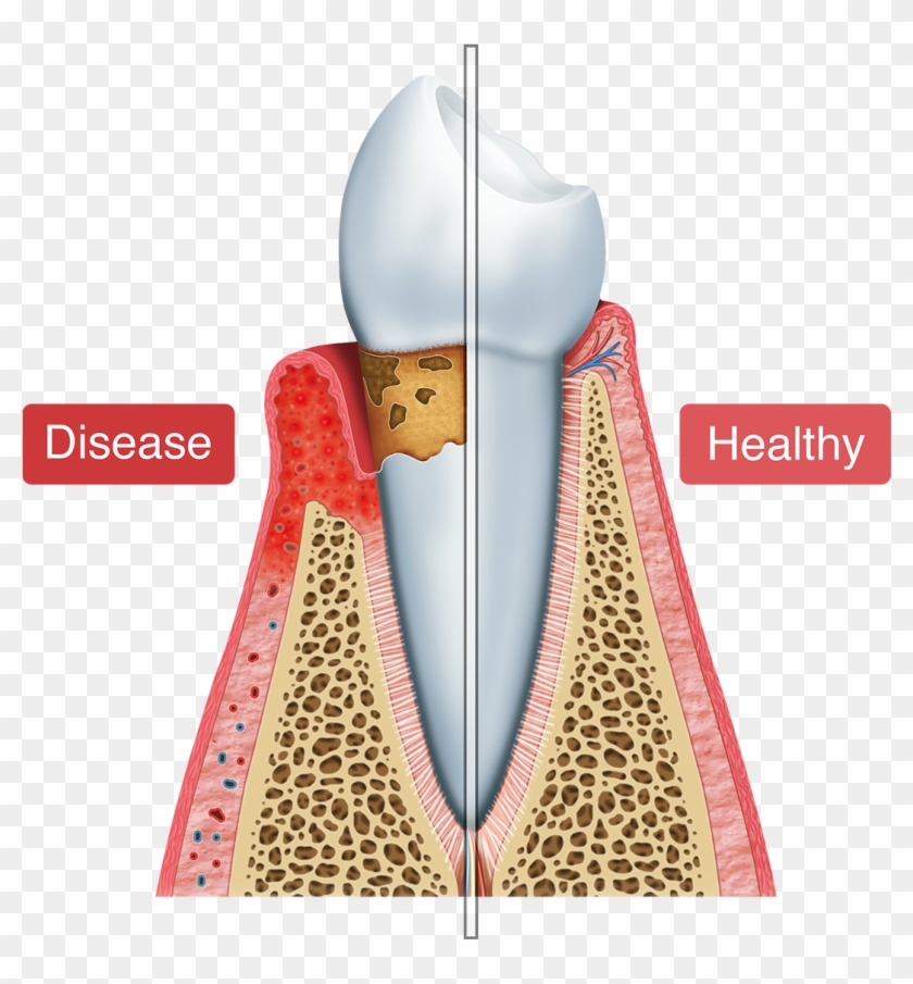 An Illustration Of Healthy Vs - Periodonto Png Clipart #3585239