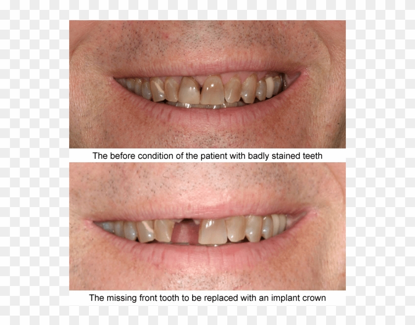 Before And After Case Examples All Of These Cases Shown - Tongue Clipart #3586420
