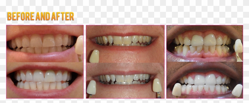 Led Teeth Whitening Coupons Led Teeth Whitening Before - Colorfulness Clipart