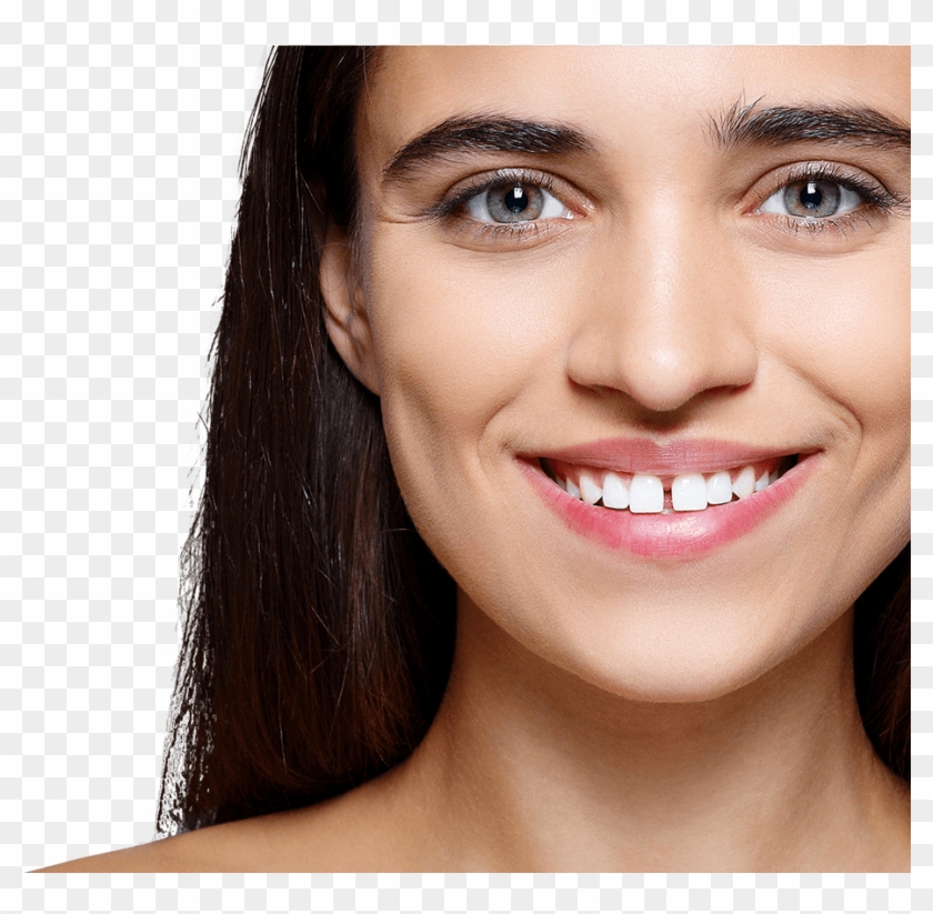 Gapped Teeth - Ayrık Dişlerde Tel Tedavisi Clipart