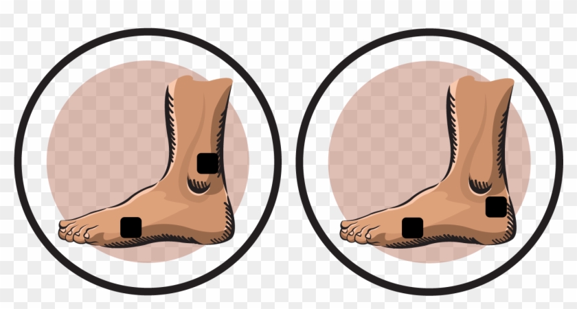 Post Podiatric Surgery-lateral Toes Electrode Pad Placements - Eletrodos Para Entorse Do Tornozelo Clipart