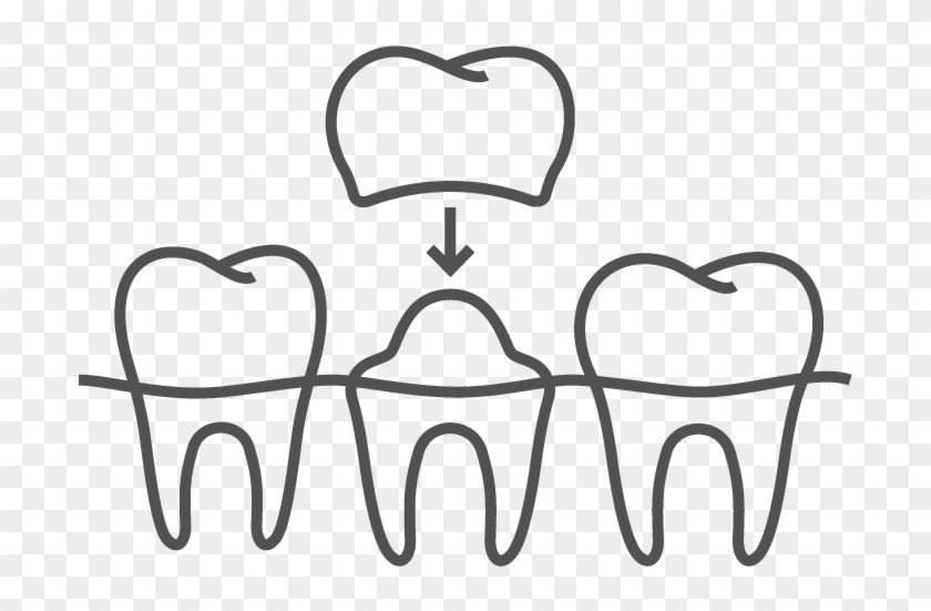Crowns & Bridges - Protesis Dental Vectores Clipart #3599268