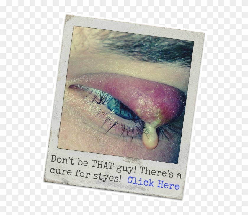 Woke Eyes Png - Stye Symptoms Clipart #366752