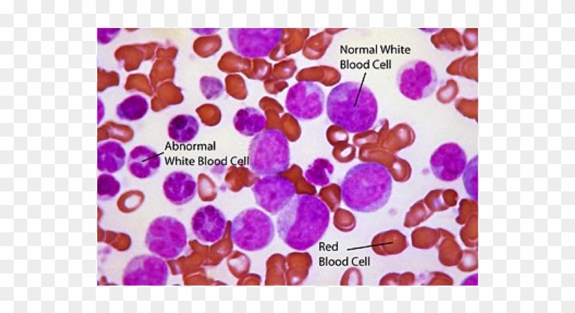 When The Leukemia Cells Crowd Out Your Normal Cells, - Blast Cell In Cml Clipart