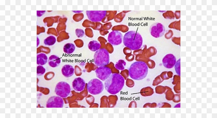 When The Leukemia Cells Crowd Out Your Normal Cells, - Blast Cell In Cml Clipart #3602612