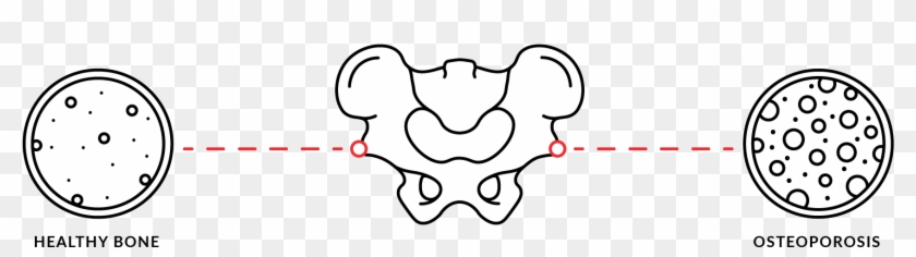 On The Other Hand, Advanced Osteoporosis Will Usually - Osteoporosis Clip Art - Png Download #3646957
