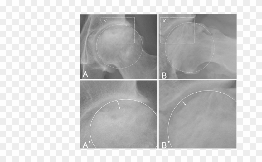 Measurement Of Femoral Head Collapse - Circle Clipart #3648518