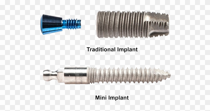 Mini Dental Implant Candidates - Dental Implant Clipart #3649364