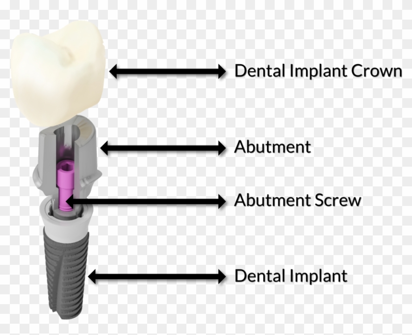 What Is The Difference Between A Dental Crown And A - Cutting Tool Clipart #3650886