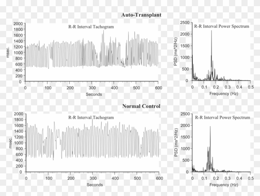 Heart Rhythms Generated By A Transplanted Heart At - Poster Clipart #3720199
