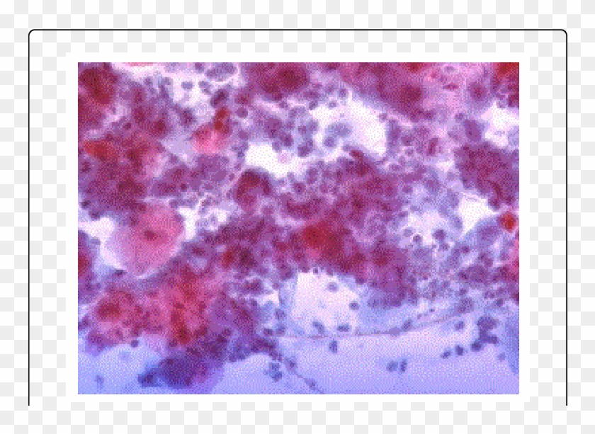 Yeast And Hyphae In Distal Esophagus Brush - Visual Arts Clipart #3720746