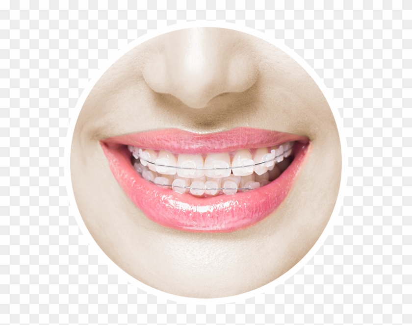 Svg Library Download Invisalign For Adults Teens More - Type Of Clear Brackets Clipart #3738557