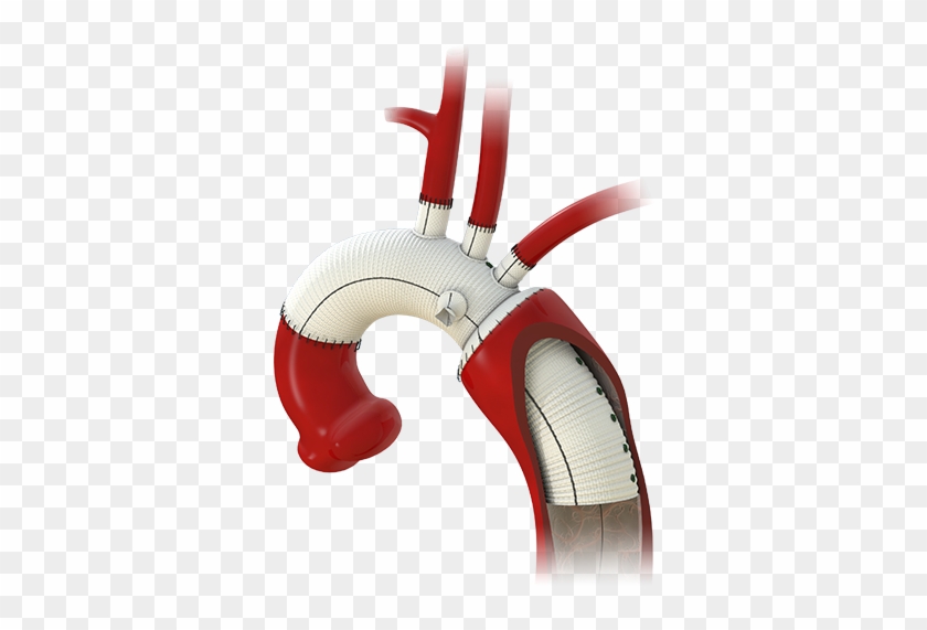 The Gelweave™ Siena Graft Used In A Modified "elephant - Elephant Trunk Graft Technique Clipart