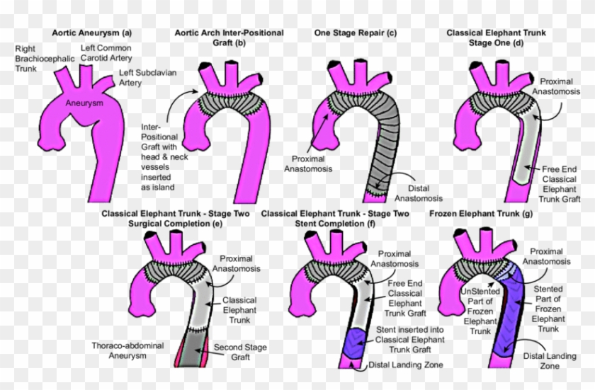Graphical Representation Of Different Techniques For - Elephant Trunk Aortic Repair Clipart