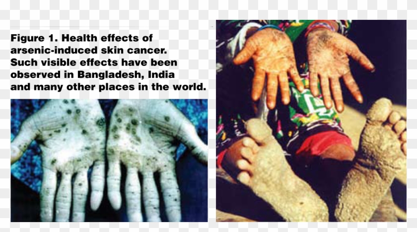 And Lymphatic System As Well As Development Of Lung - Disease Caused By E Waste Clipart