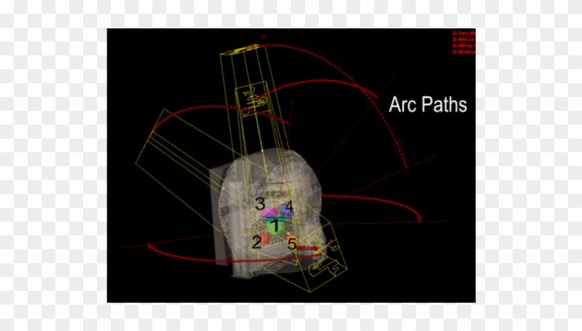 5-arc Rapidarc Radiosurgery Plan Treating 5 Targets - Circle Clipart #386910