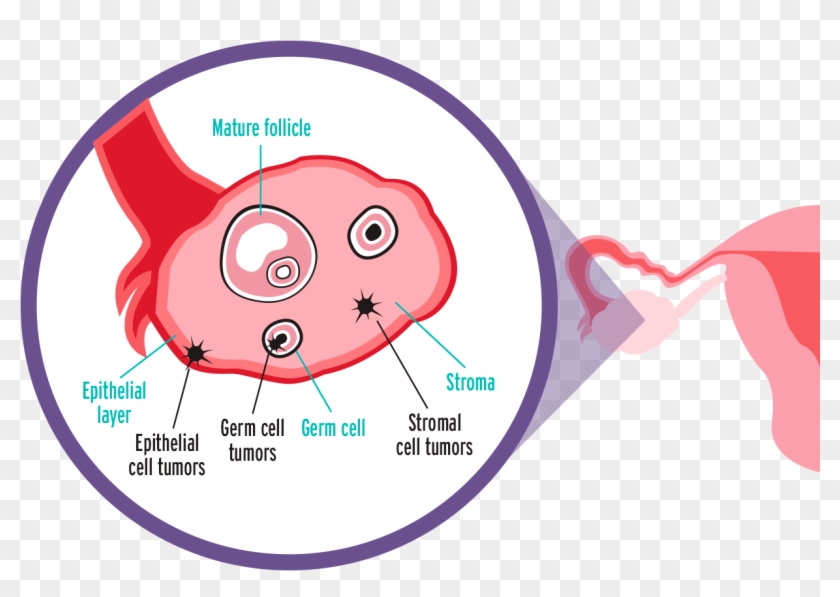 Epithelial Ovarian Carcinoma Clipart