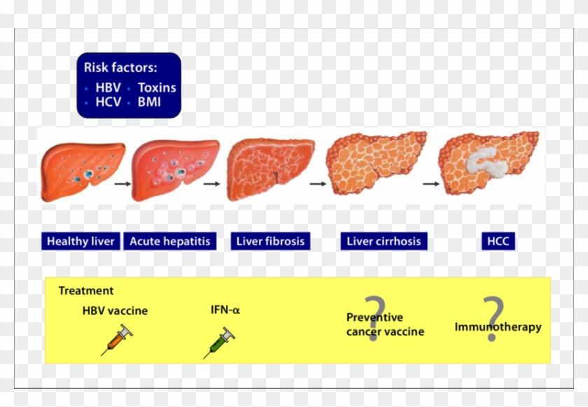 An Immunogenic Tumor - Hepatitis B Clipart