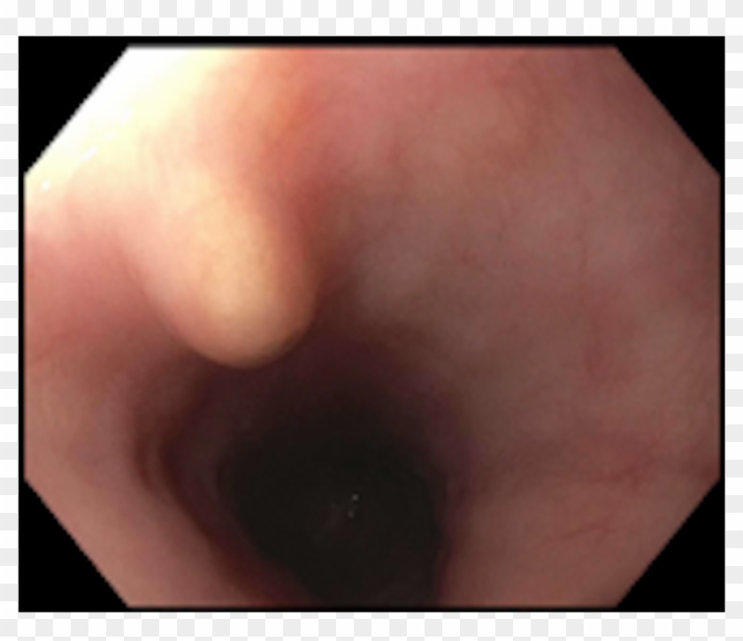 Intact Granular Cell Tumor - Granular Cell Tumor Egd Clipart