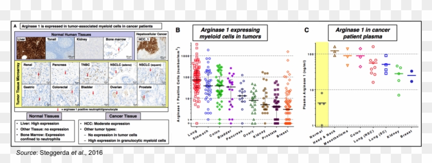 Arginase Expression 2 - Arginase 1 In Tumors Clipart