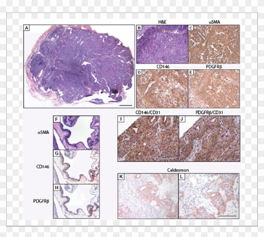 Pericytic Immunophenotype Of Glomus Tumor - Mineral Clipart #3906378