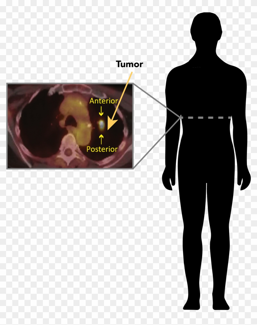 Healthy Cells And Cancer Cells Use Sugar Differently - Standing Clipart