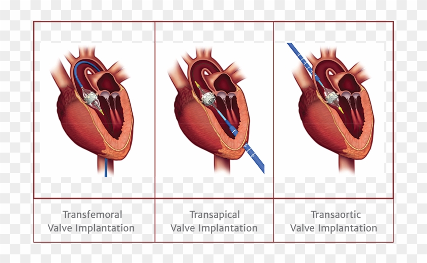 Transaortic Valve Clipart