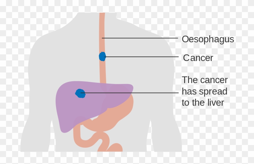 Esophagus Cancer Symptoms - Esophageal Cancer Clipart #3990284