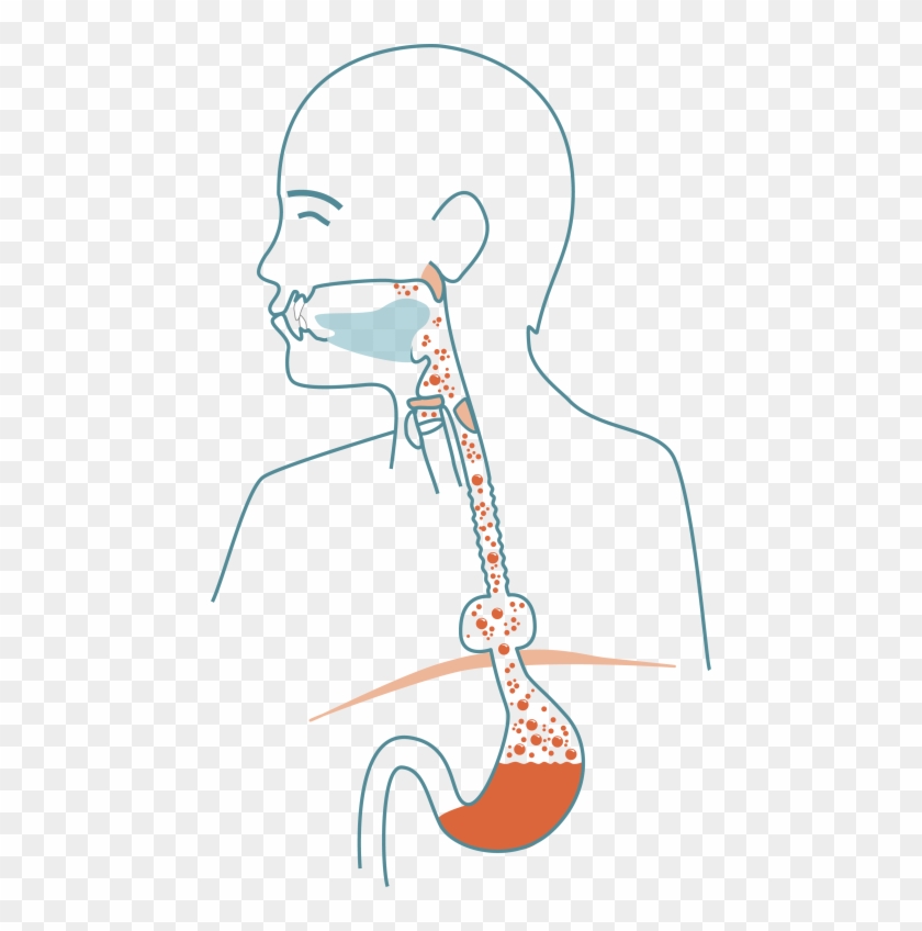 Hiatal Hernia Means That The Aperture In The Diaphragm - Illustration Clipart #3990335