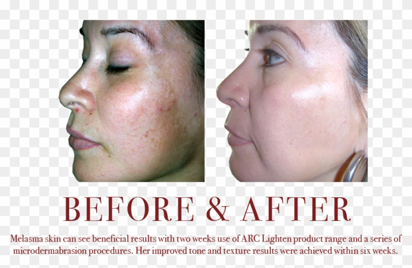 Lightening Melasma Mottled Skin Tone Discolorations - Mottled Hyperpigmentation Clipart