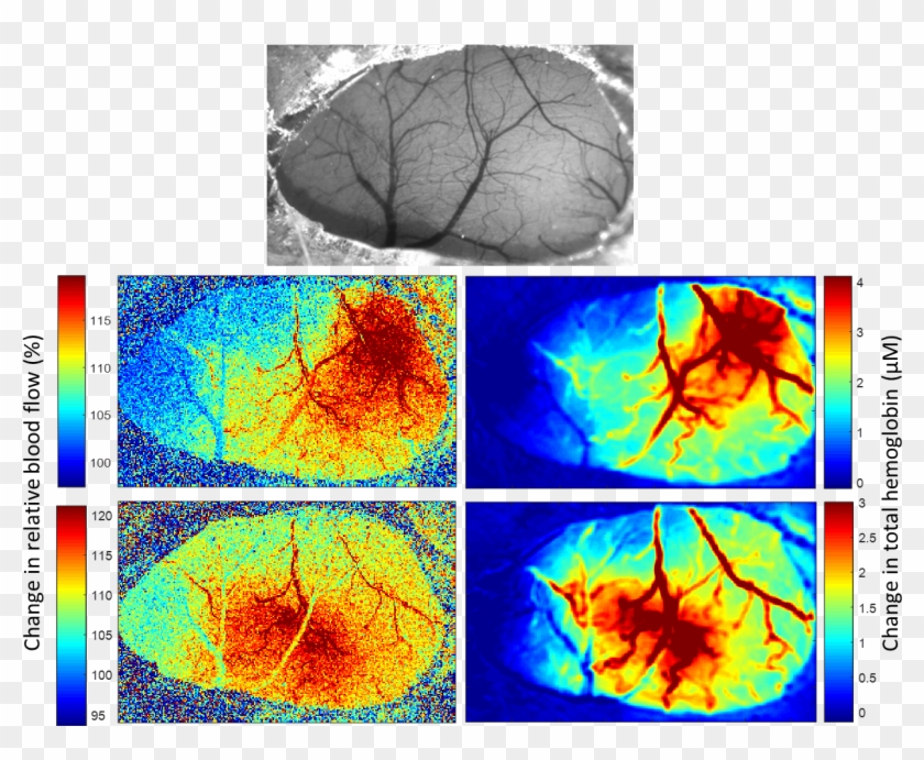 Laser Speckle Contrast Imaging And Multispectral Imaging - Laser Speckle Contrast Imaging Stroke Clipart #4032413