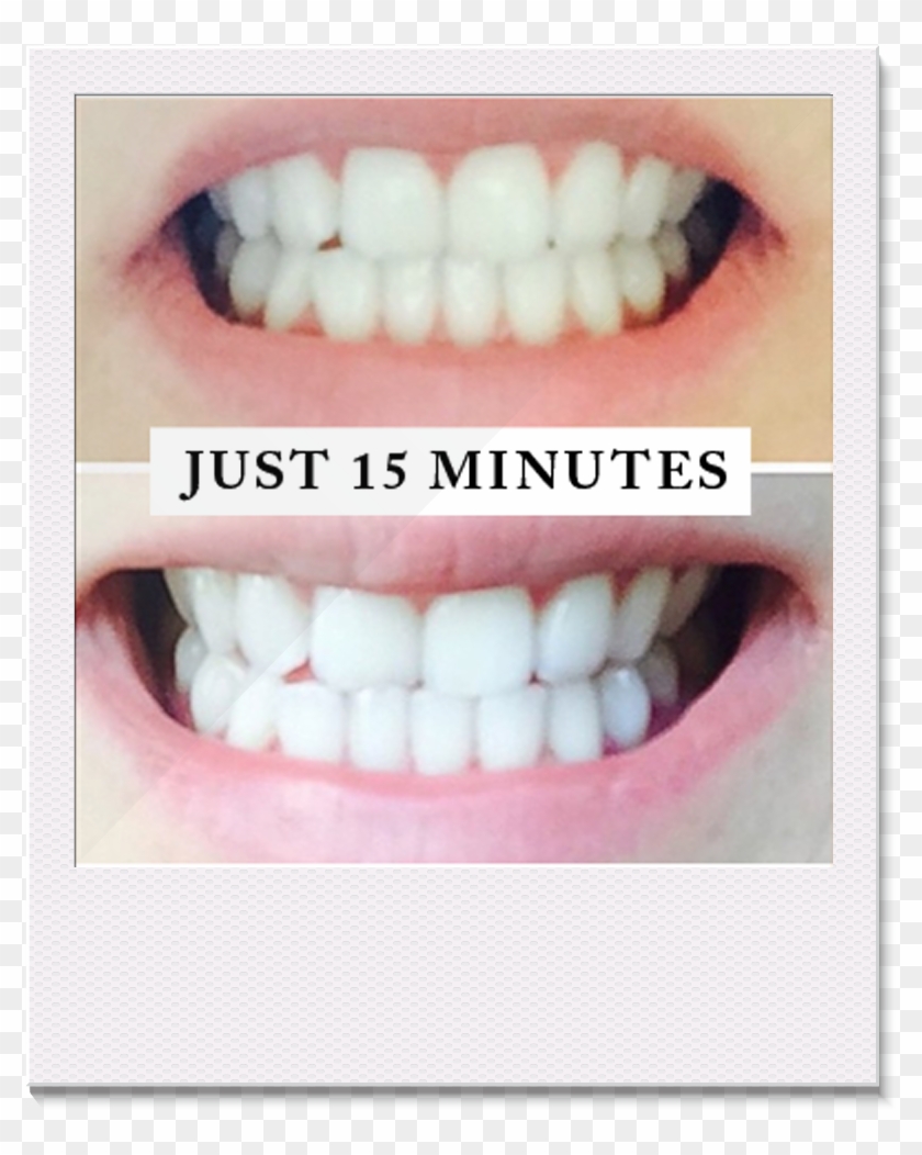 Professional Teeth Whitening System - Pearly White Review Clipart