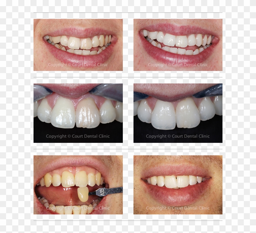 Tooth Beaconsfield Buckinghamshire Court Dental Clinic - Lip Gloss Clipart